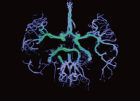 検査結果で脳血流を示したMRAの画像