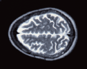 検査結果で脳を示したMRIの画像